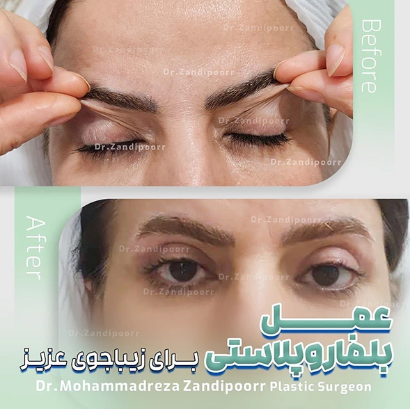 عمل بلفاروپلاستی