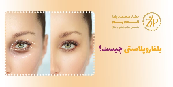 بلفاروپلاستی چیست؟