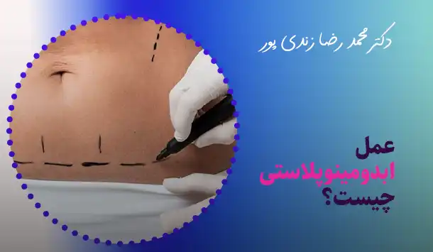 عمل ابدومینوپلاستی چیست؟