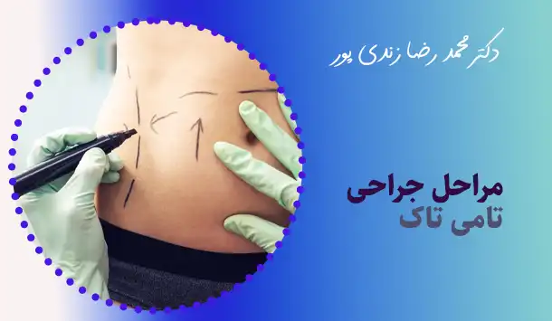 مراحل جراحی تامی تاک