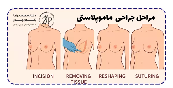 مراحل جراحی ماموپلاستی