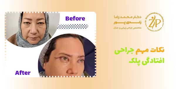 نکات مهم جراحی افتادگی پلک