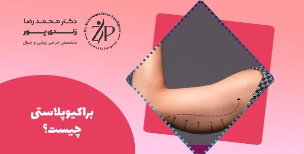 براکیوپلاستی چیست؟