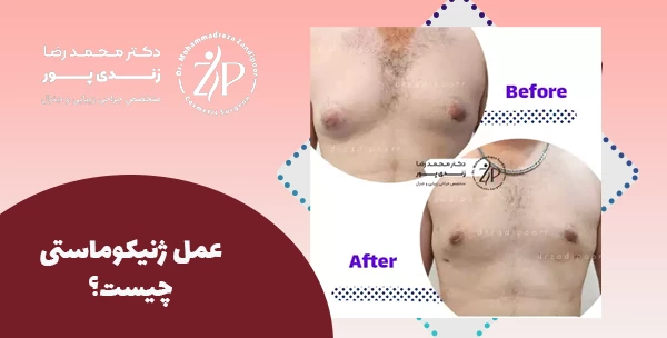 عمل ژنیکوماستی چیست؟