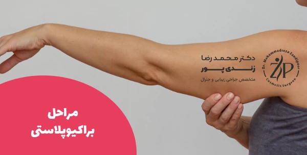 مراحل براکیوپلاستی