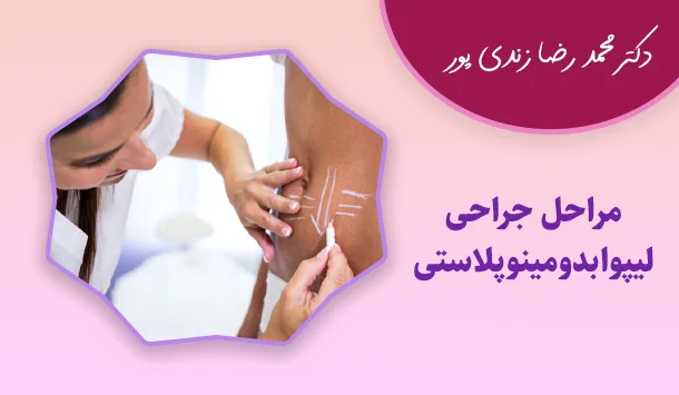 مراحل جراحی لیپوابدومینوپلاستی