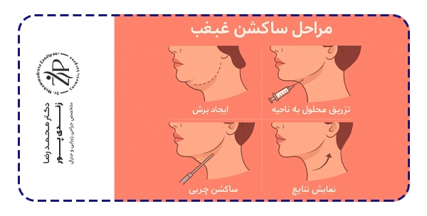 مراحل ساکشن غبغب