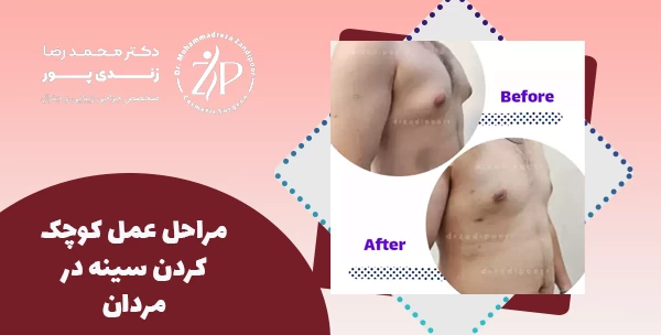 مراحل عمل کوچک کردن سینه در مردان