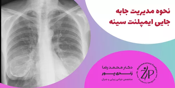 نحوه مدیریت جابه‌جایی ایمپلنت سینه 