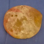 عفونت پروتز سينه