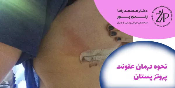 نحوه درمان عفونت پروتز پستان