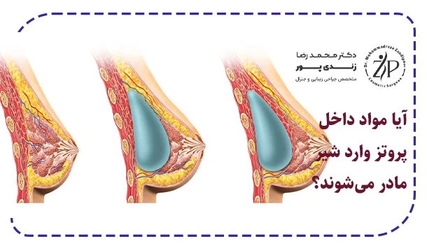 آیا مواد داخل پروتز وارد شیر مادر می‌شوند؟