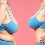 افتادگی سینه بعد از پروتز