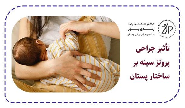 تأثیر جراحی پروتز سینه بر ساختار پستان