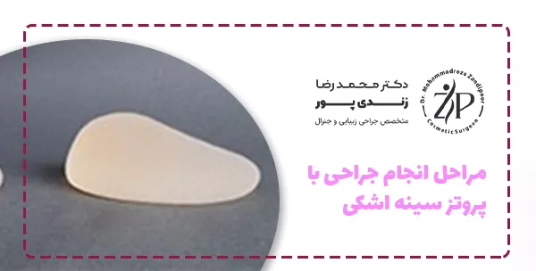 مراحل انجام جراحی با پروتز سینه اشکی
