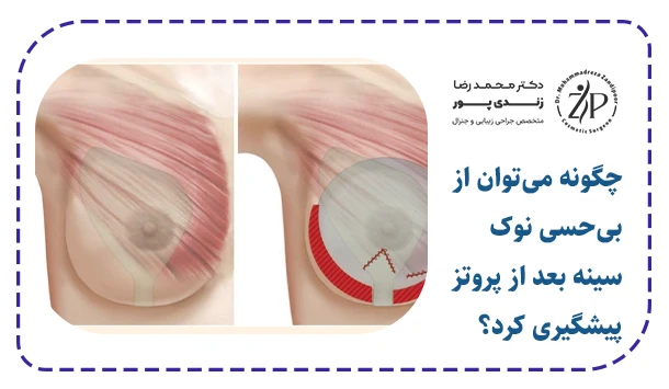 چگونه می‌توان از بی‌حسی نوک سینه بعد از پروتز پیشگیری کرد؟