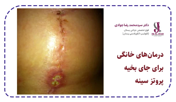 درمان‌های خانگی برای جای بخیه پروتز سینه