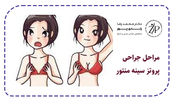 مراحل جراحی پروتز سینه منتور