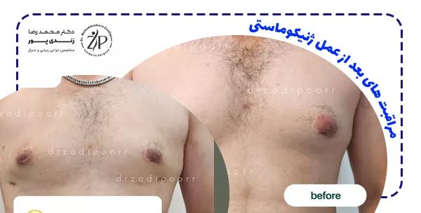 مراقبت های بعد از عمل ژنیکوماستی