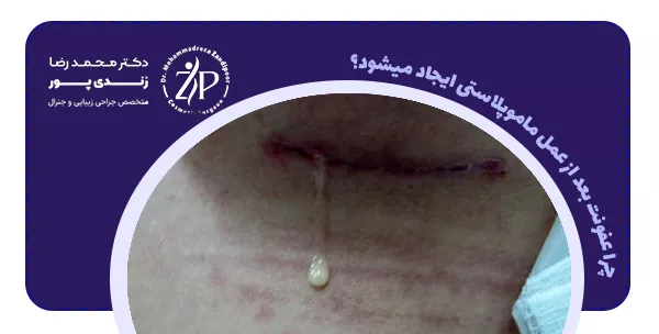 چرا عفونت بعد از عمل ماموپلاستی ایجاد می شود؟
