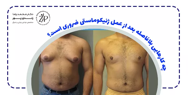 چه کارهایی بلافاصله بعد از عمل ژنیکوماستی ضروری است؟