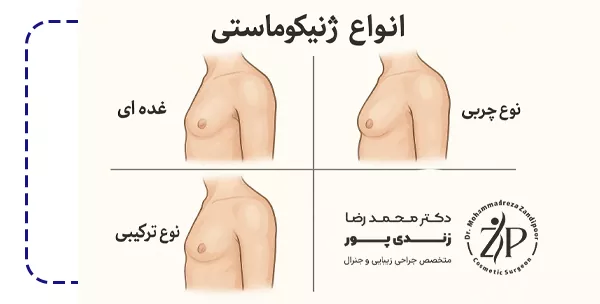 انواع ژنیکوماستی از لحاظ ساختار