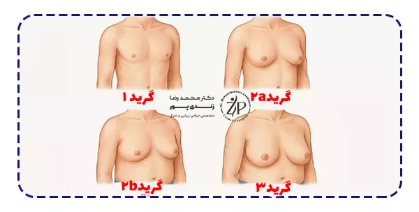 انواع گرید های ژنیکوماستی