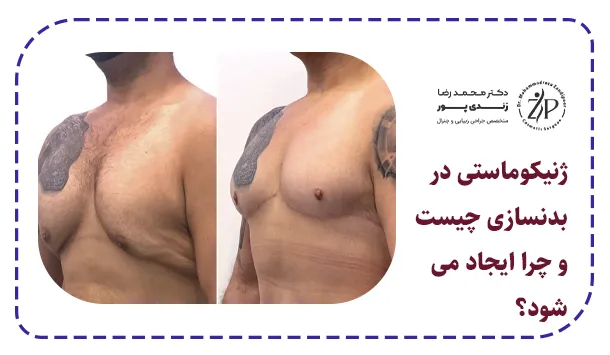 ژنیکوماستی در بدنسازی چیست و چرا ایجاد می شود؟