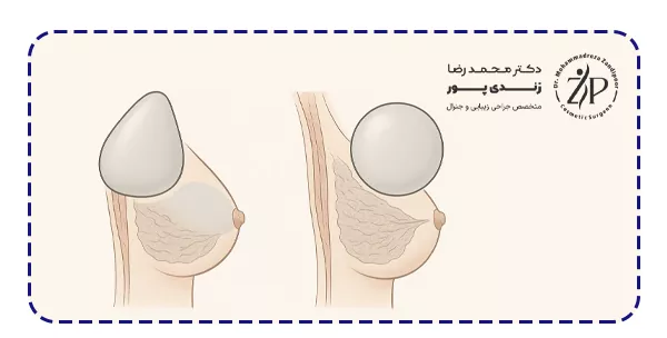 تفاوت پروتز سینه اشکی و گرد در چیست؟