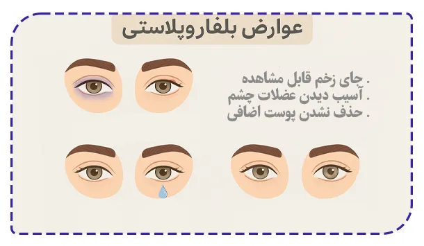 عوارض بلفاروپلاستی