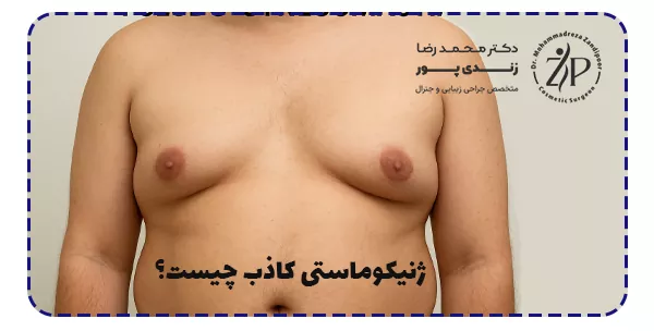 ژنیکوماستی کاذب چیست؟