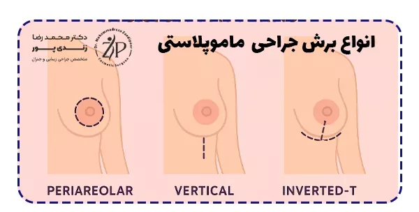 انواع برش در ماموپلاستی