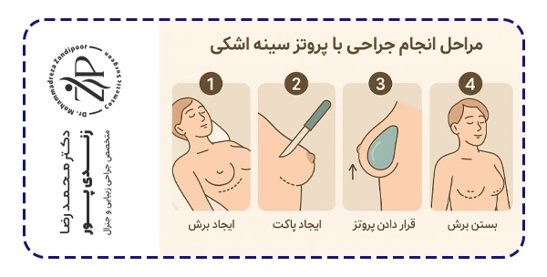 مراحل جراحی پروتز سینه با پروتز اشکی